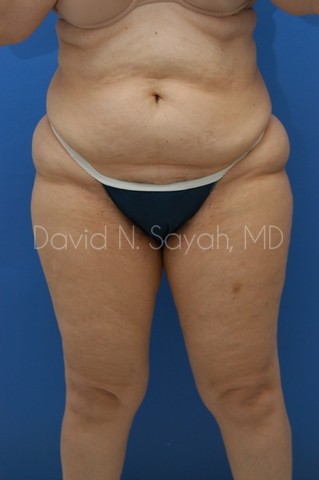 Liposuction Before and After | Sayah Institute