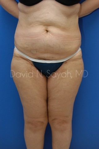 Liposuction Before and After | Sayah Institute