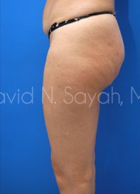 Liposuction Before and After | Sayah Institute