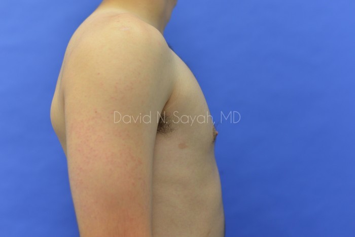 Male Breast Surgery Before and After | Sayah Institute