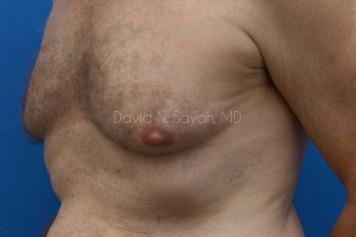 Male Breast Surgery Before and After | Sayah Institute