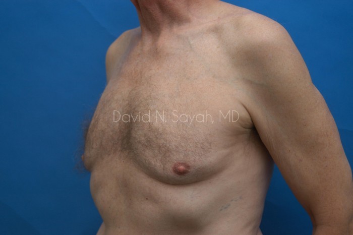 Male Breast Surgery Before and After | Sayah Institute