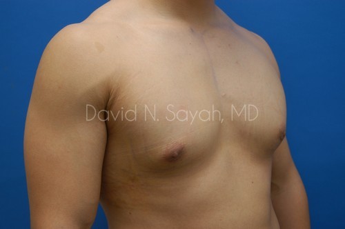 Male Breast Surgery Before and After | Sayah Institute