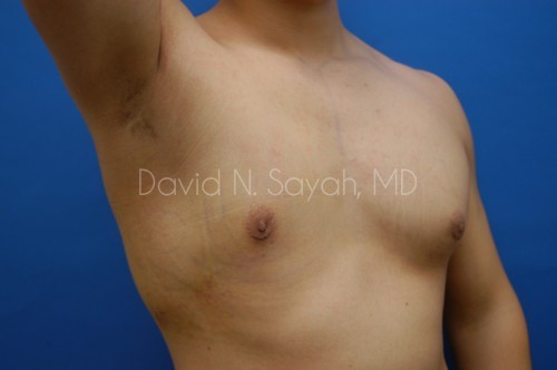 Male Breast Surgery Before and After | Sayah Institute