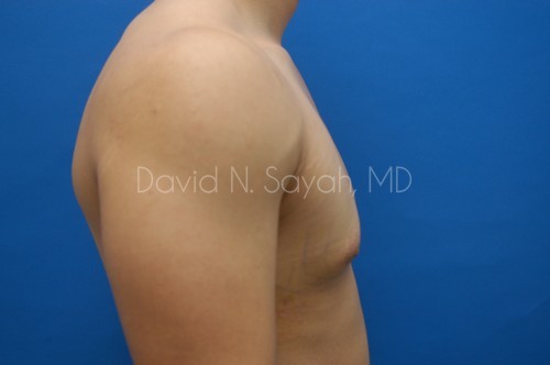 Male Breast Surgery Before and After | Sayah Institute