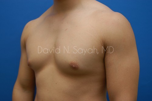 Male Breast Surgery Before and After | Sayah Institute