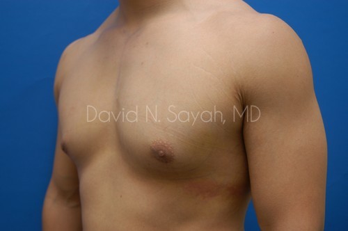 Male Breast Surgery Before and After | Sayah Institute