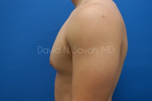 Male Breast Surgery Before and After | Sayah Institute