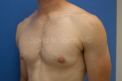Male Breast Surgery Before and After | Sayah Institute