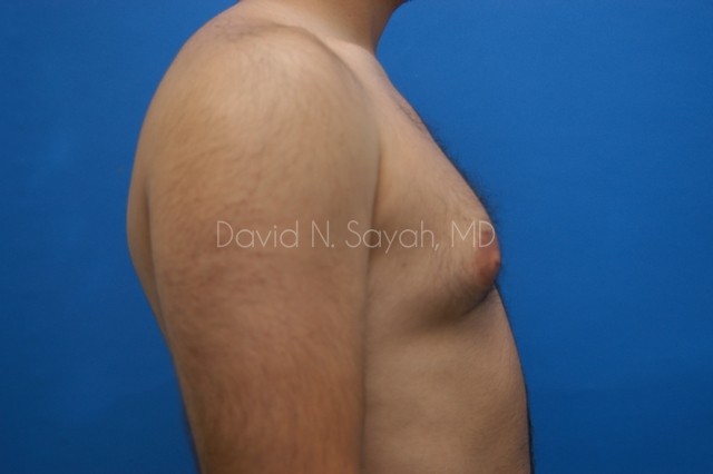 Male Breast Surgery Before and After | Sayah Institute