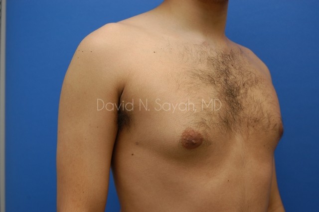 Male Breast Surgery Before and After | Sayah Institute