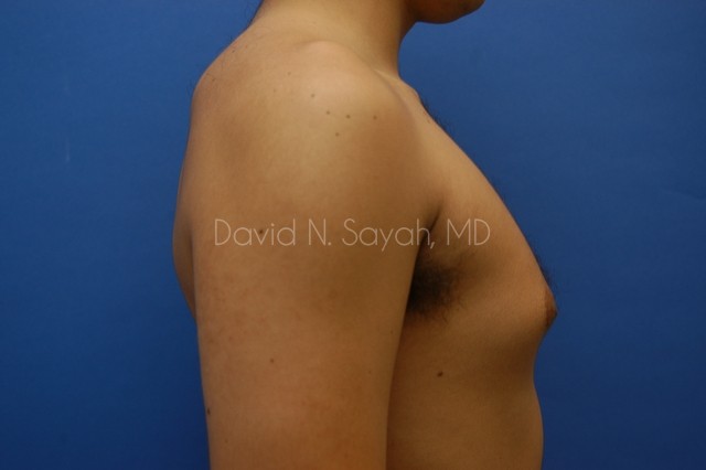 Male Breast Surgery Before and After | Sayah Institute