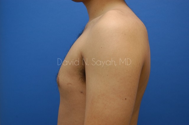 Male Breast Surgery Before and After | Sayah Institute