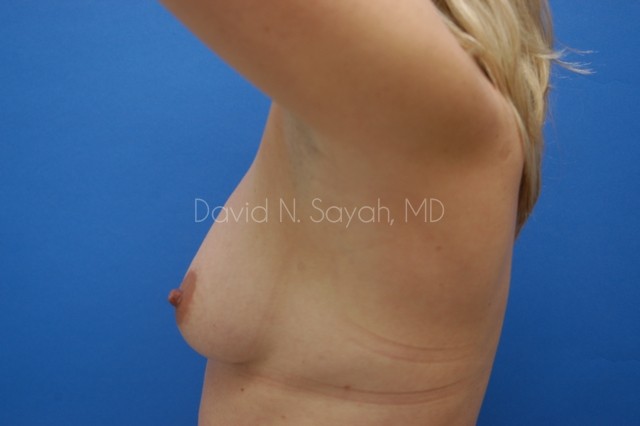 Mommy Makeover Before and After | Sayah Institute