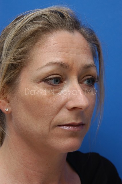 Mommy Makeover Before and After | Sayah Institute