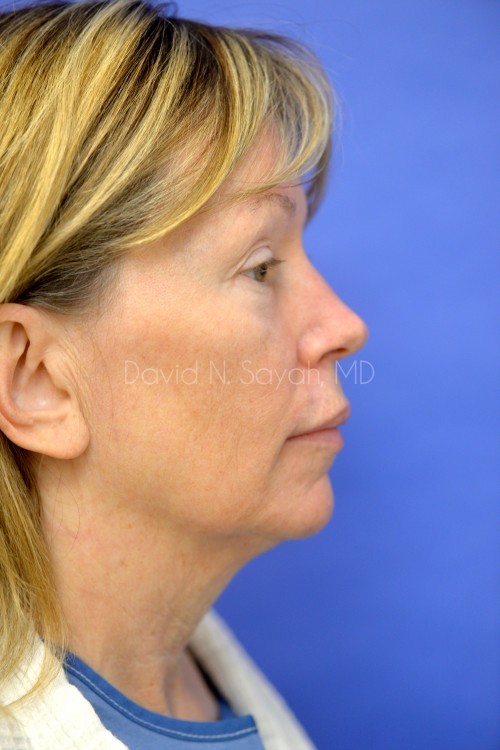 Neck Lift Before and After | Sayah Institute