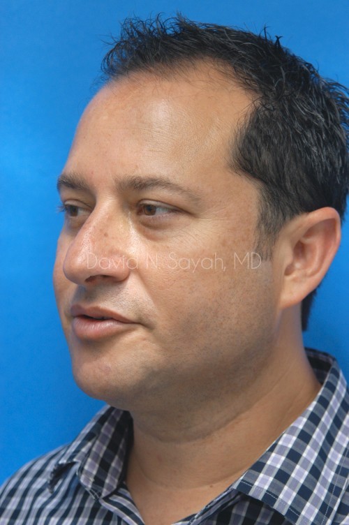 Neck Lift Before and After | Sayah Institute