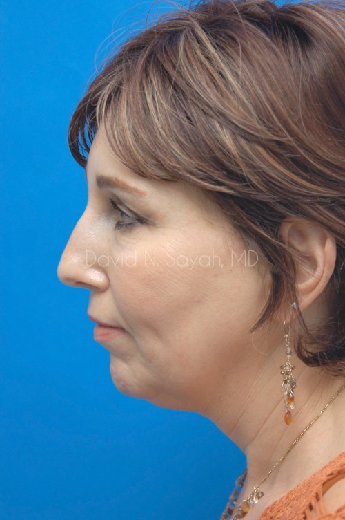 Neck Lift Before and After | Sayah Institute