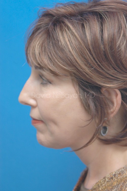 Neck Lift Before and After | Sayah Institute