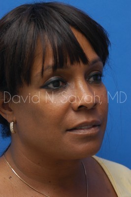 Neck Lift Before and After | Sayah Institute