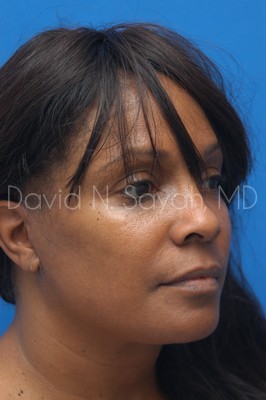 Neck Lift Before and After | Sayah Institute
