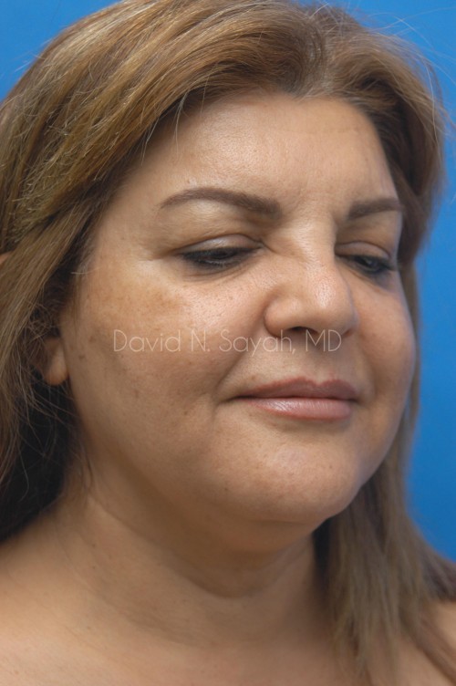 Neck Lift Before and After | Sayah Institute