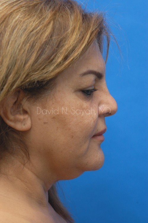 Neck Lift Before and After | Sayah Institute