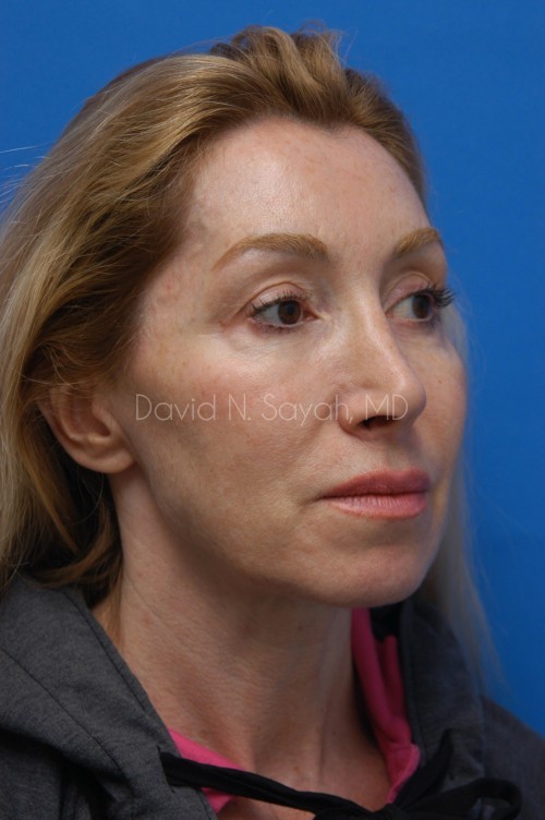Neck Lift Before and After | Sayah Institute