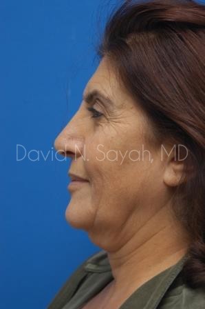 Neck Lift Before and After | Sayah Institute