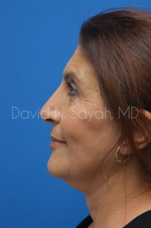 Neck Lift Before and After | Sayah Institute