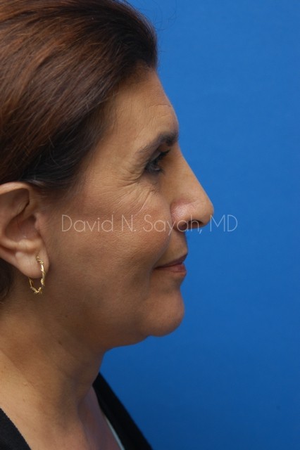 Neck Lift Before and After | Sayah Institute