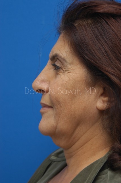 Neck Lift Before and After | Sayah Institute