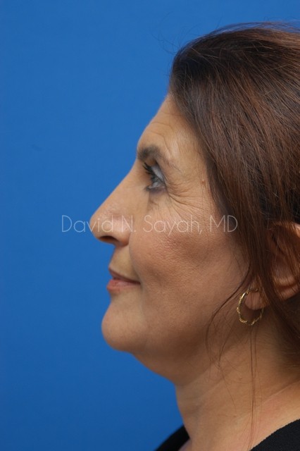 Neck Lift Before and After | Sayah Institute