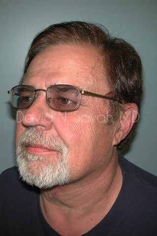 Neck Lift Before and After | Sayah Institute