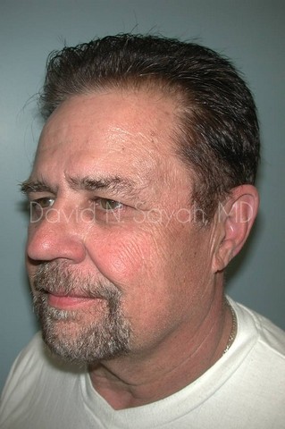 Neck Lift Before and After | Sayah Institute