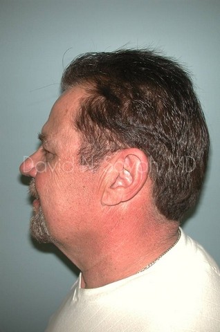 Neck Lift Before and After | Sayah Institute