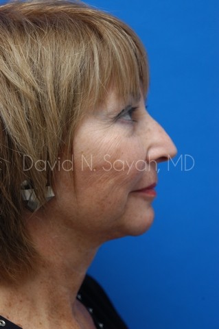 Neck Lift Before and After | Sayah Institute