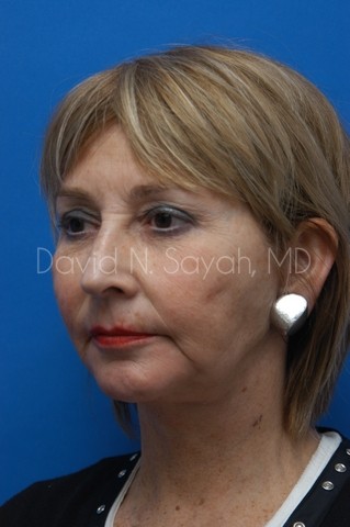 Neck Lift Before and After | Sayah Institute