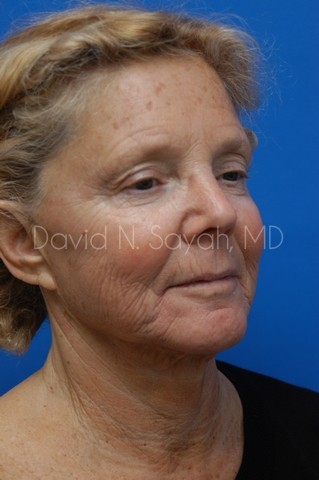 Neck Lift Before and After | Sayah Institute