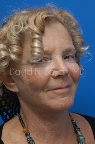 Neck Lift Before and After | Sayah Institute