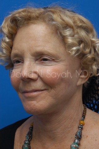 Neck Lift Before and After | Sayah Institute