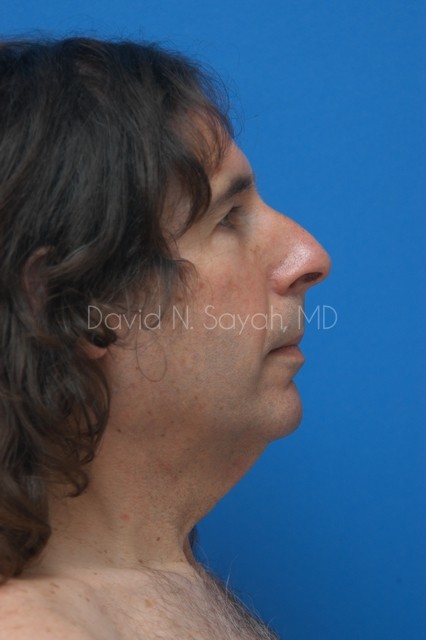 Neck Lift Before and After | Sayah Institute