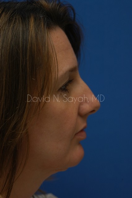 Neck Lift Before and After | Sayah Institute