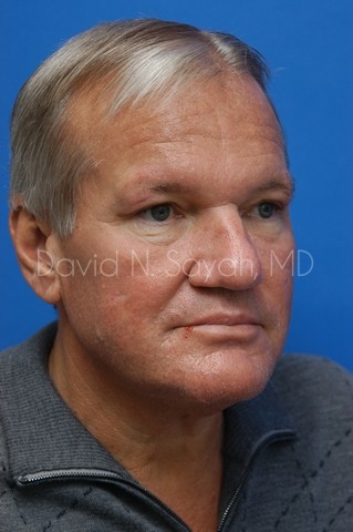 Neck Lift Before and After | Sayah Institute