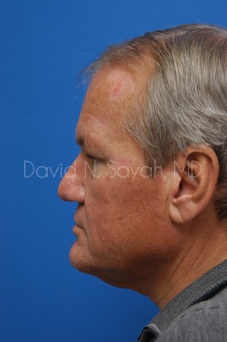 Neck Lift Before and After | Sayah Institute