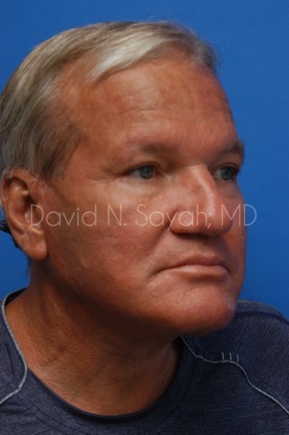 Neck Lift Before and After | Sayah Institute