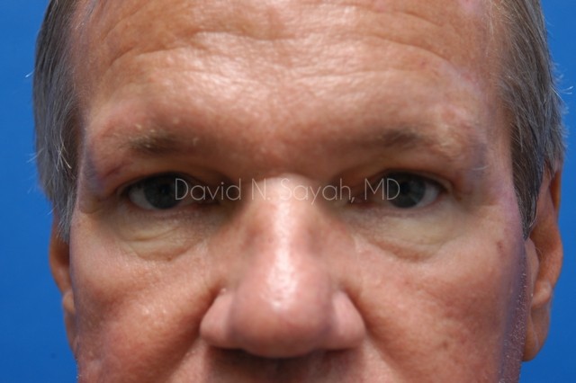 Neck Lift Before and After | Sayah Institute