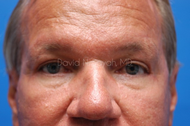 Neck Lift Before and After | Sayah Institute