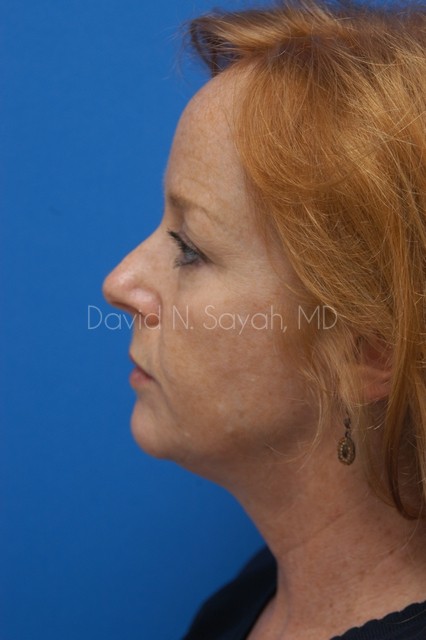 Neck Lift Before and After | Sayah Institute