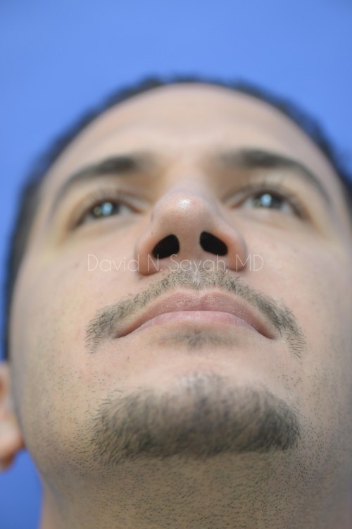 Rhinoplasty Before and After | Sayah Institute